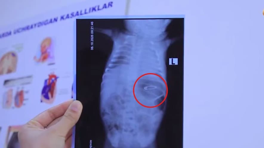 Buxoroda 14 kunlik chaqaloq oshqozonidan to‘g‘nog‘ich olindi